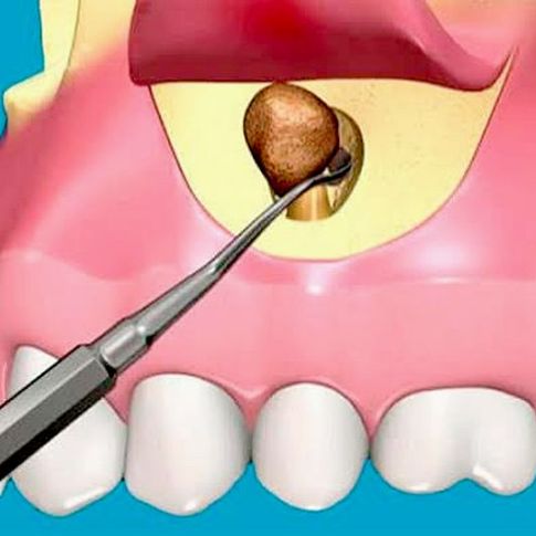 DIPLOMADO EN CIRUGÍA PERIAPICAL